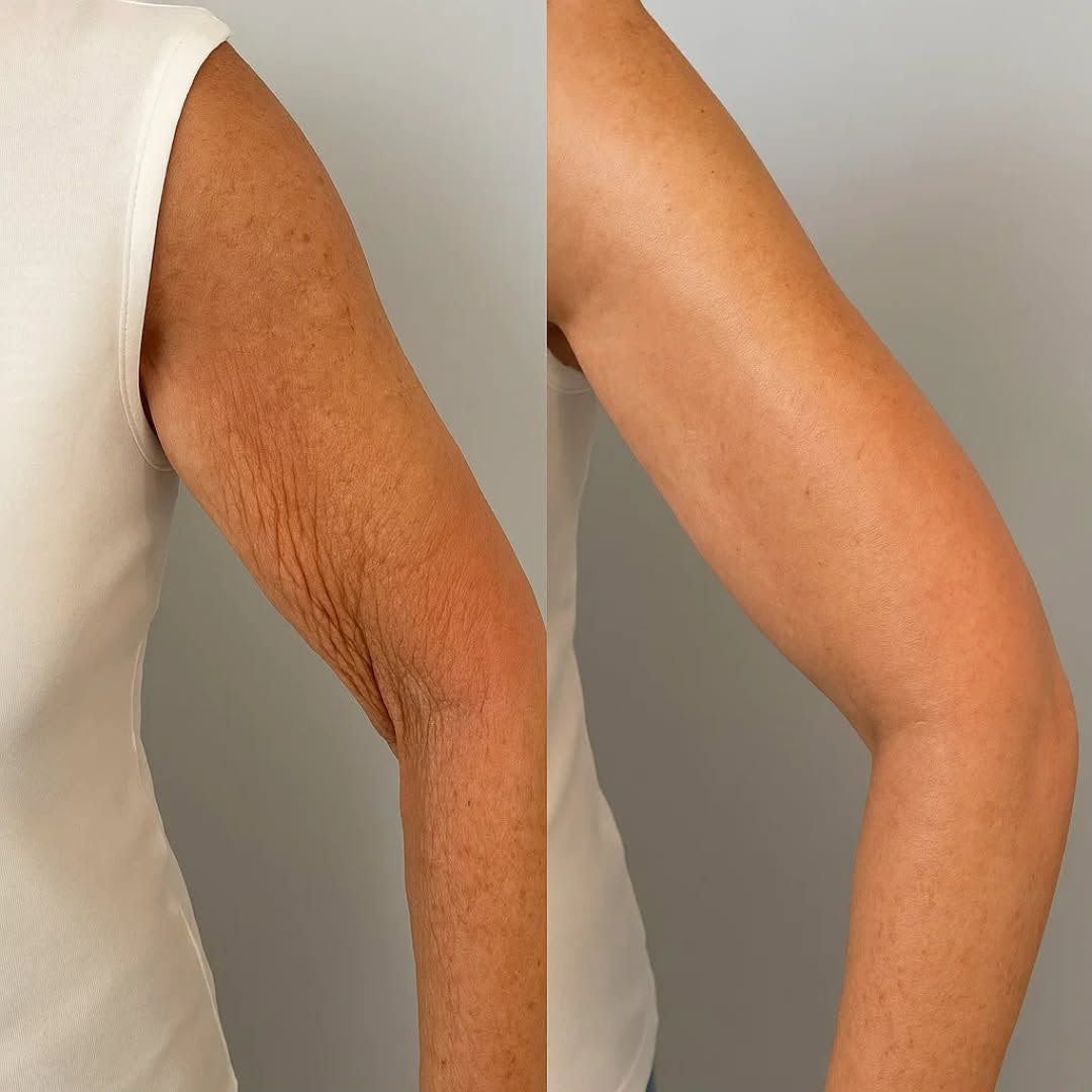 Biolifting Completo Braccia, trattamento estetico non invasivo al Giorgia P Beauty Lab, Roma zona EUR