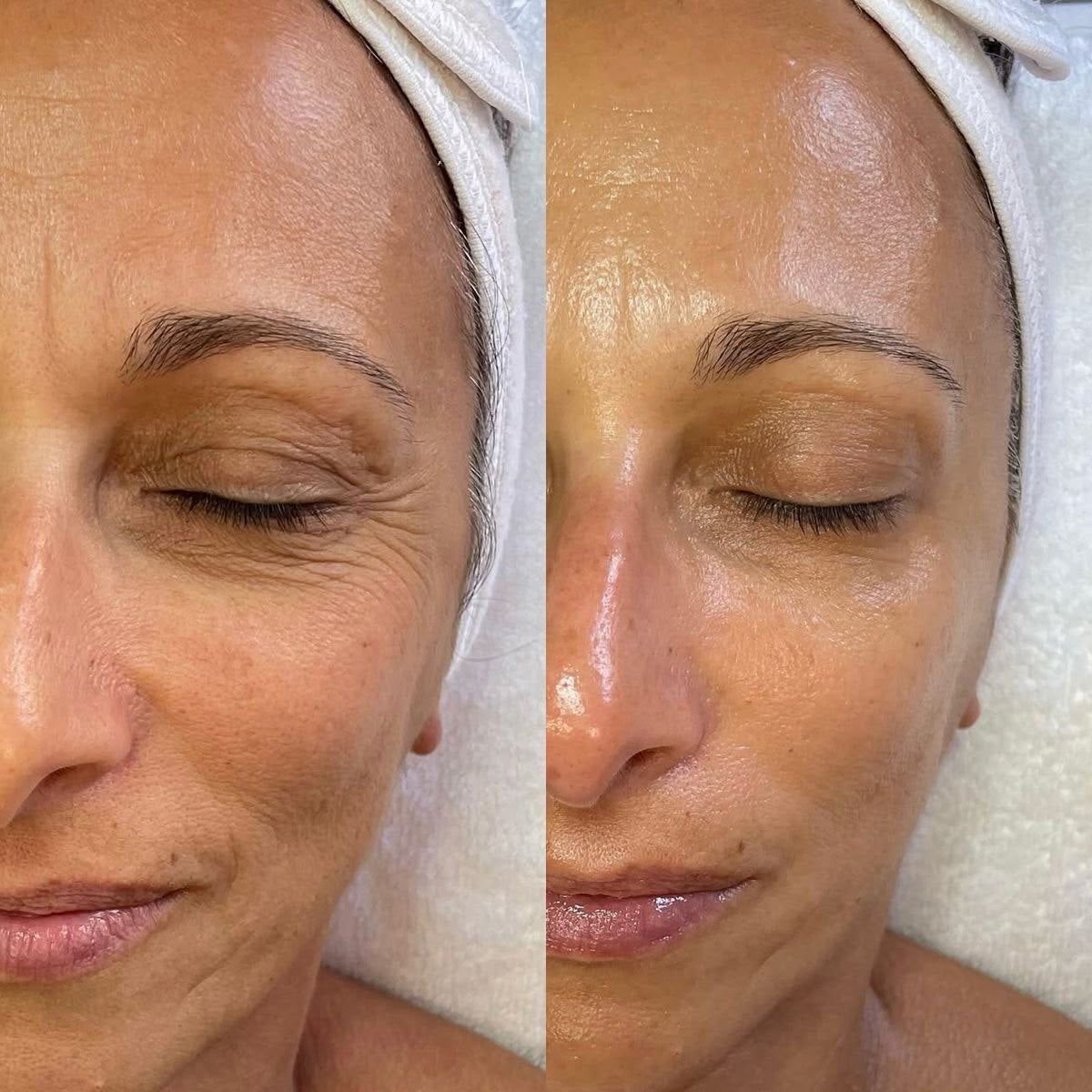 Biolifting, trattamento estetico non invasivo al Giorgia P Beauty Lab, Roma zona EUR