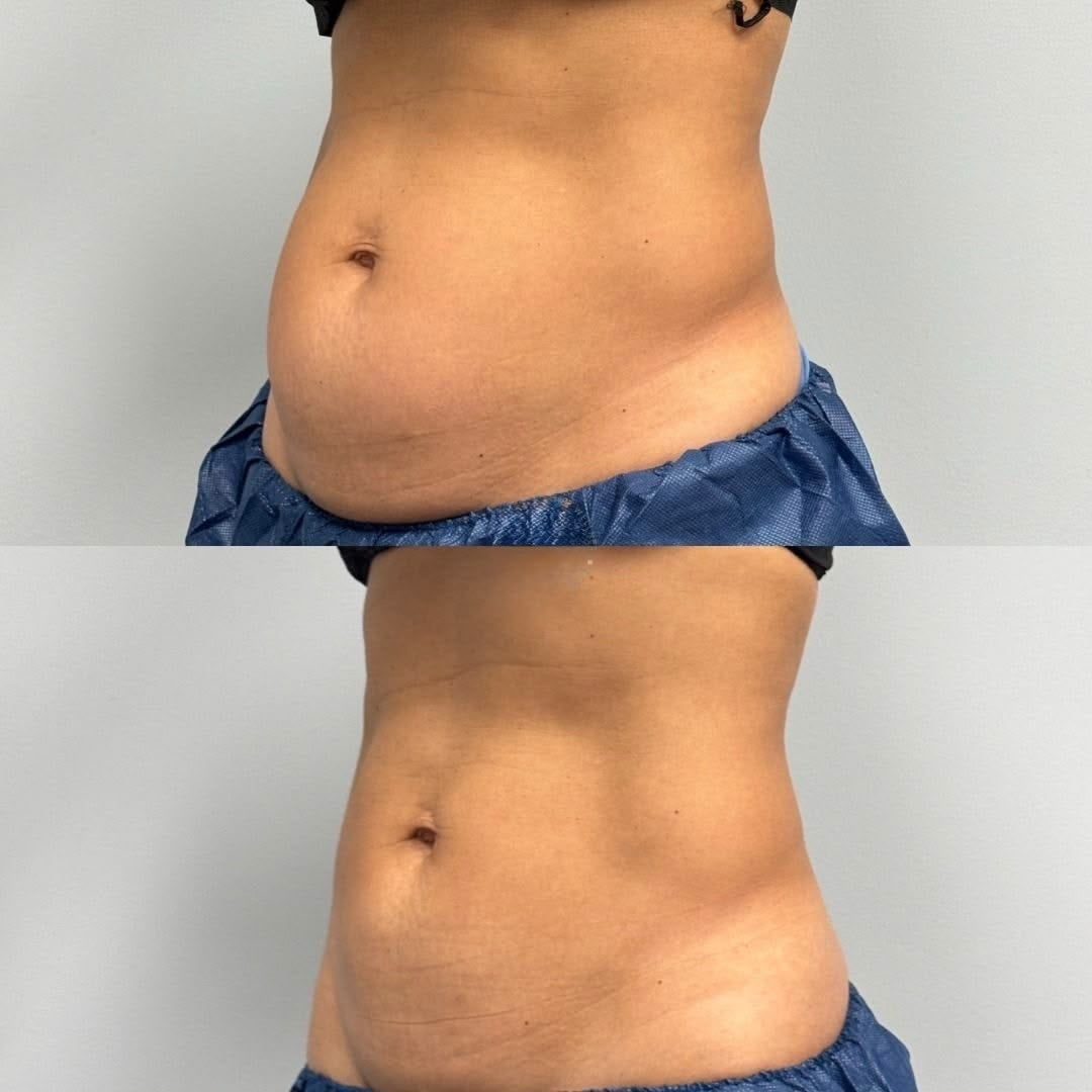 Crioliposcultura, trattamento estetico non invasivo al Giorgia P Beauty Lab, Roma zona EUR