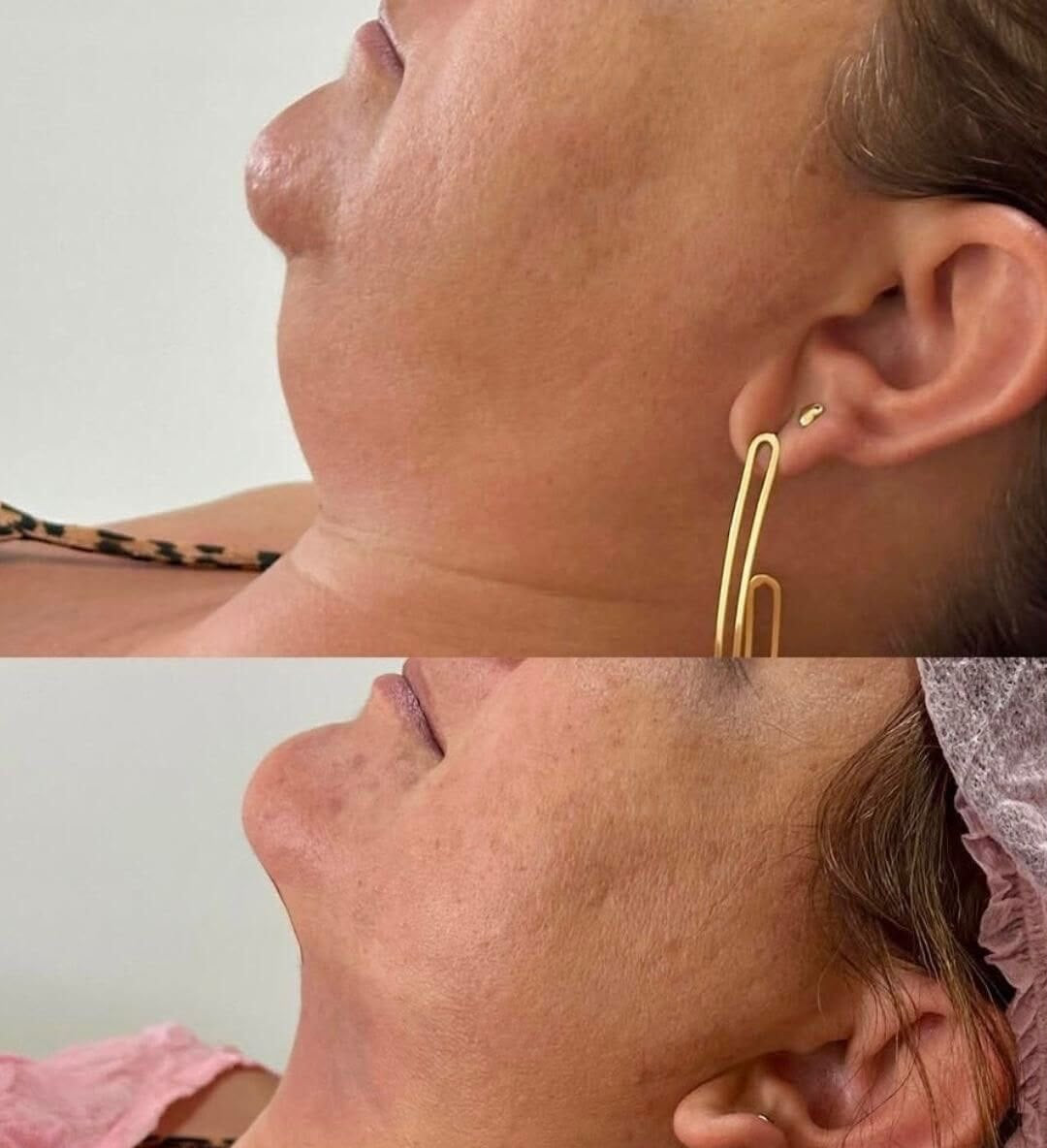 Protocollo Sottomento e Profilo Mandibolare, trattamento estetico non invasivo al Giorgia P Beauty Lab, Roma zona EUR