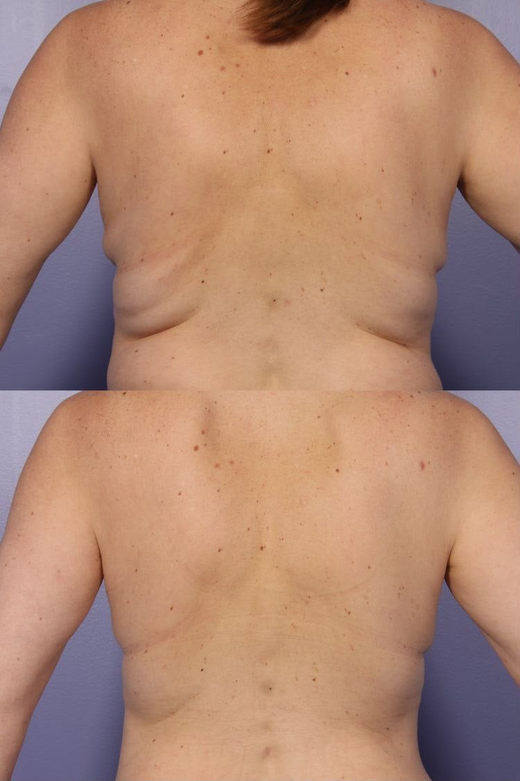 Fiale Lipolitiche con Biolifting, trattamento estetico non invasivo al Giorgia P Beauty Lab, Roma zona EUR