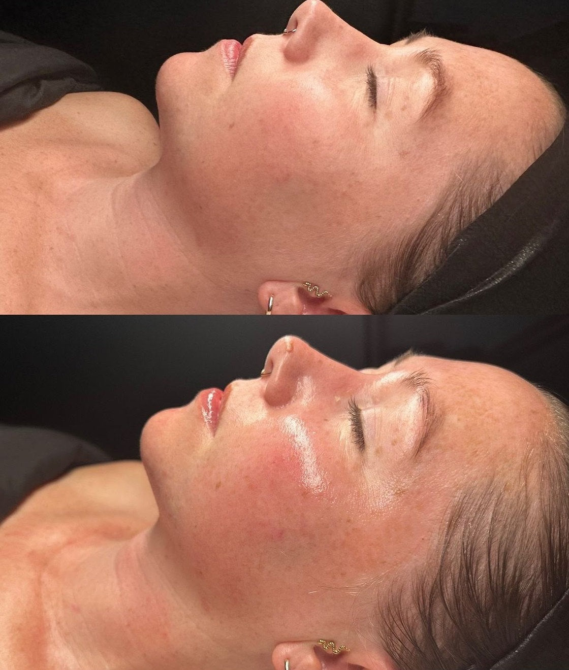 Fotoringiovanimento, trattamento estetico non invasivo al Giorgia P Beauty Lab, Roma zona EUR
