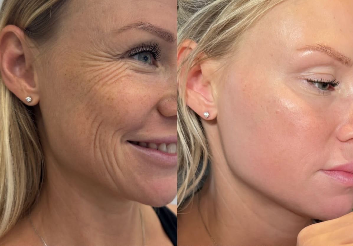 Laserlifting con Fiala Distensiva, trattamento estetico non invasivo al Giorgia P Beauty Lab, Roma zona EUR