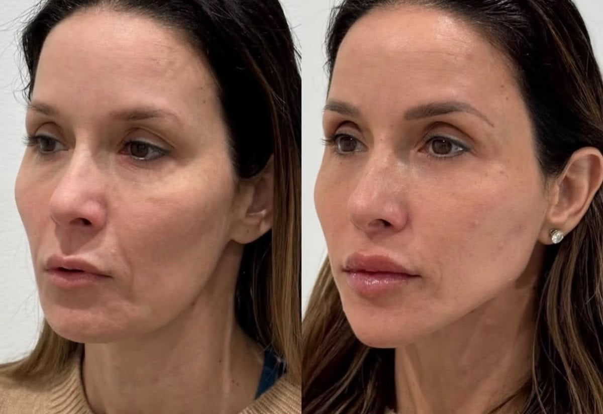 Lifting Non Chirurgico, trattamento estetico non invasivo al Giorgia P Beauty Lab, Roma zona EUR