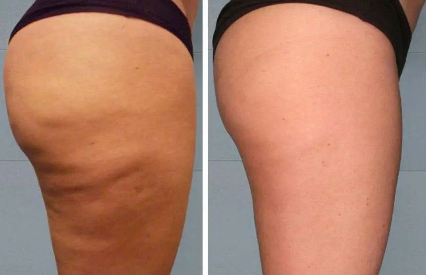 Lipocavitazione, trattamento estetico non invasivo al Giorgia P Beauty Lab, Roma zona EUR
