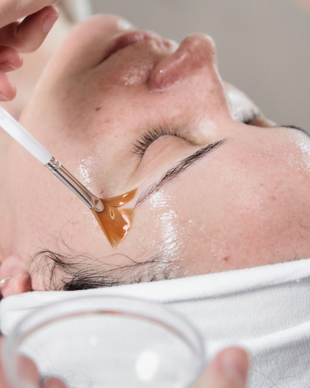 Acido AHA, trattamento estetico non invasivo al Giorgia P Beauty Lab, Roma zona EUR