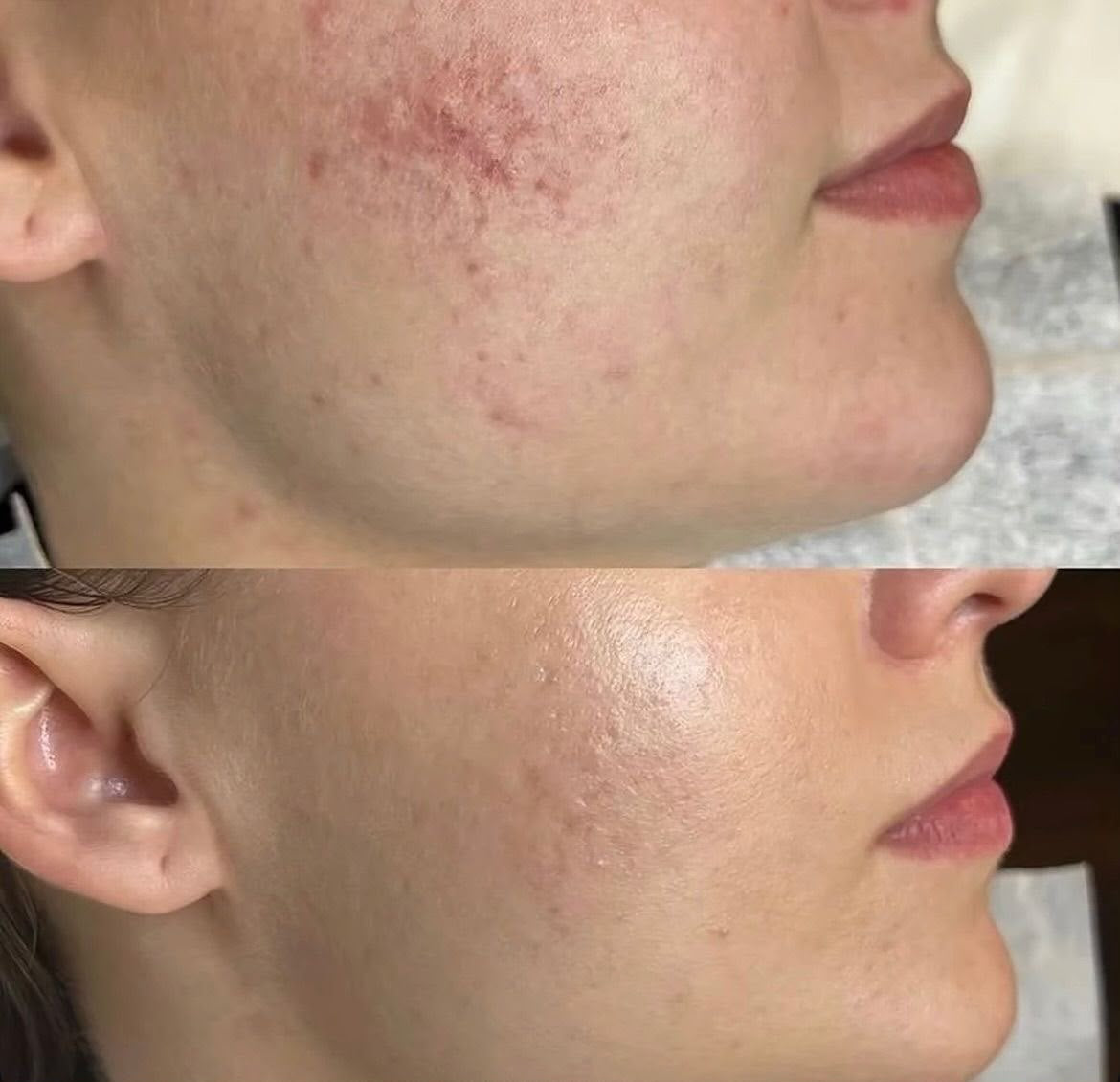 Plasma Glow, trattamento estetico non invasivo al Giorgia P Beauty Lab, Roma zona EUR