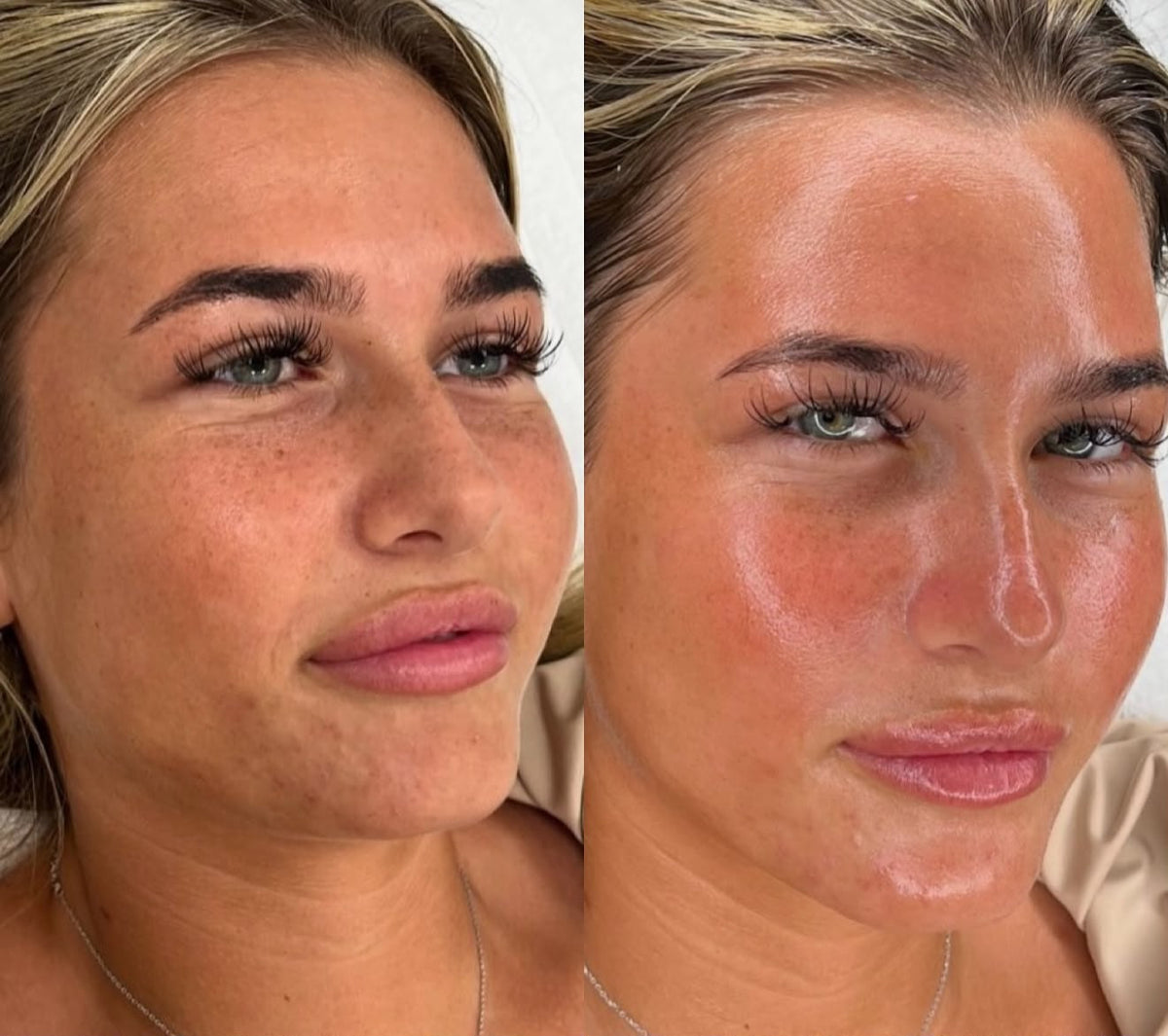 Radiofrequenza Viso, trattamento estetico non invasivo al Giorgia P Beauty Lab, Roma zona EUR